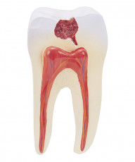 عکس دندان و عصب