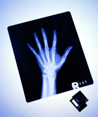 عکس رادیولوژی انگشت دست