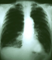 عکس رادیولوژی قفسه سینه