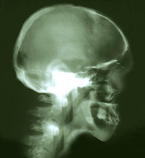 عکس رادیولوژی از جمجمه