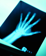 عکس رادیولوژی دست